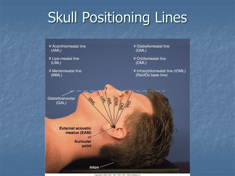 Skull Positioning Lines